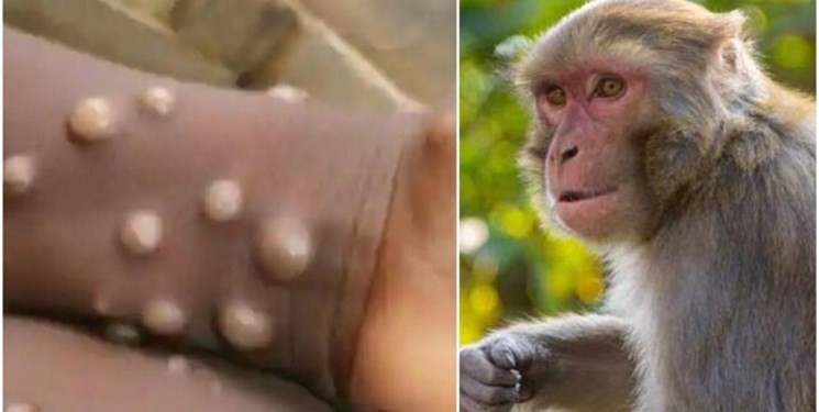 ایمنی زایی ۸۵ درصدی واکسن آبله در برابر آبله میمون/ انتظار نمی‌رود آبله میمون پاندمی ایجاد کند